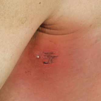 Skin Irritation on the Left Side of the Back